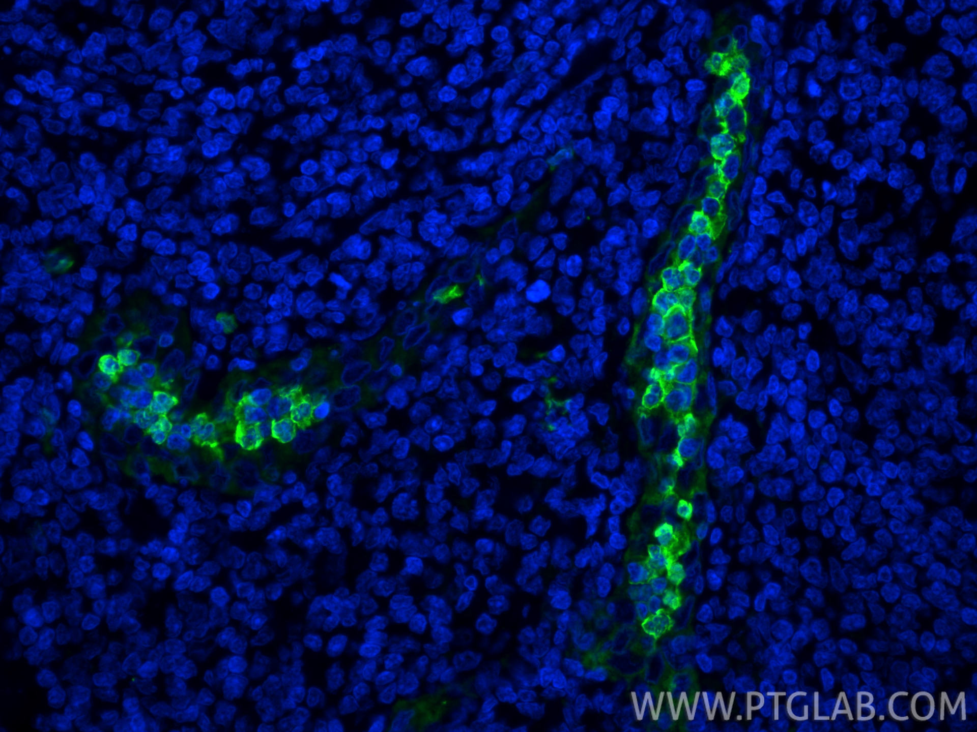 Immunofluorescent analysis of (4% PFA) fixed paraffin-embedded human tonsillitis tissue using S100A9 antibody (26992-1-AP) at dilution of 1:200 and CoraLite®488-Conjugated Goat Anti-Rabbit IgG(H+L) (<a class='green' href='/productredirect?CatalogNo=SA00013-2' target='_blank'>SA00013-2</a>). Heat mediated antigen retrieval with Tris-EDTA buffer (pH 9.0). IF Staining of human tonsillitis using 26992-1-AP