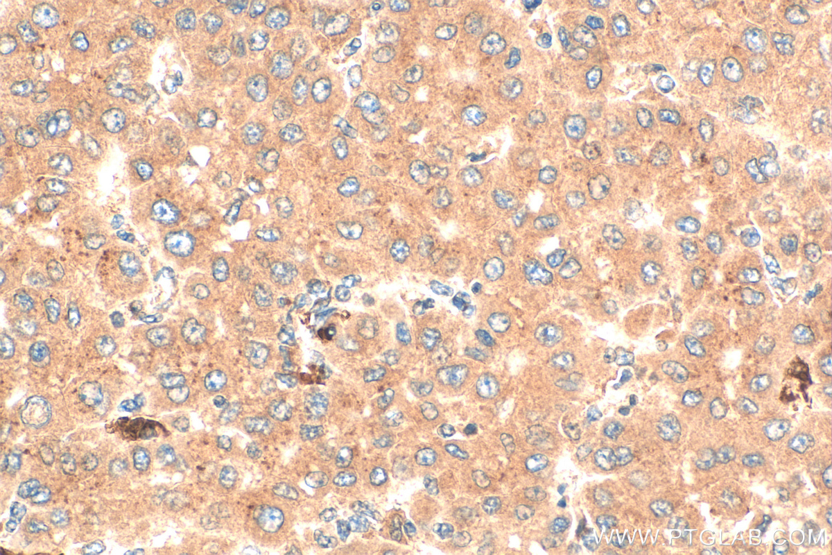 IHC staining of human liver cancer using 26992-1-AP
