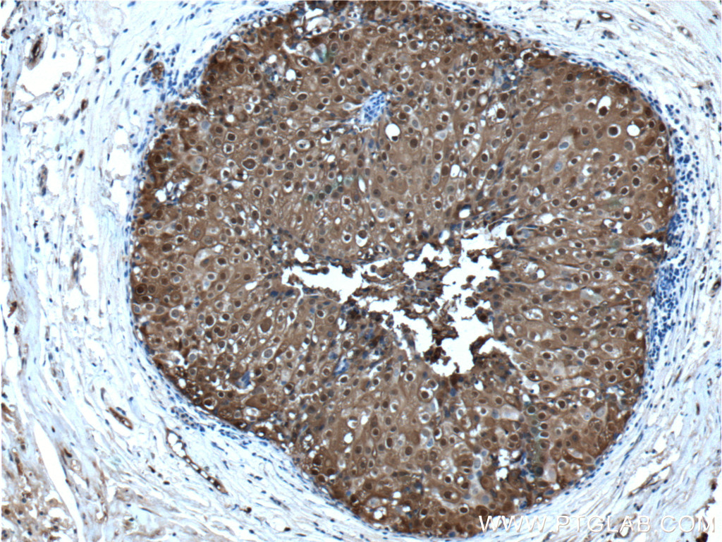 IHC staining of human breast cancer using 26992-1-AP