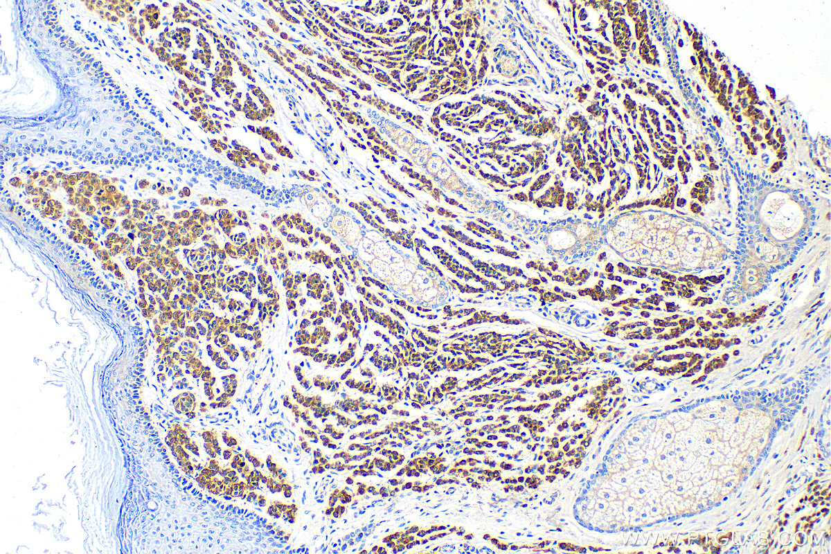 IHC staining of human malignant melanoma using 15146-1-AP