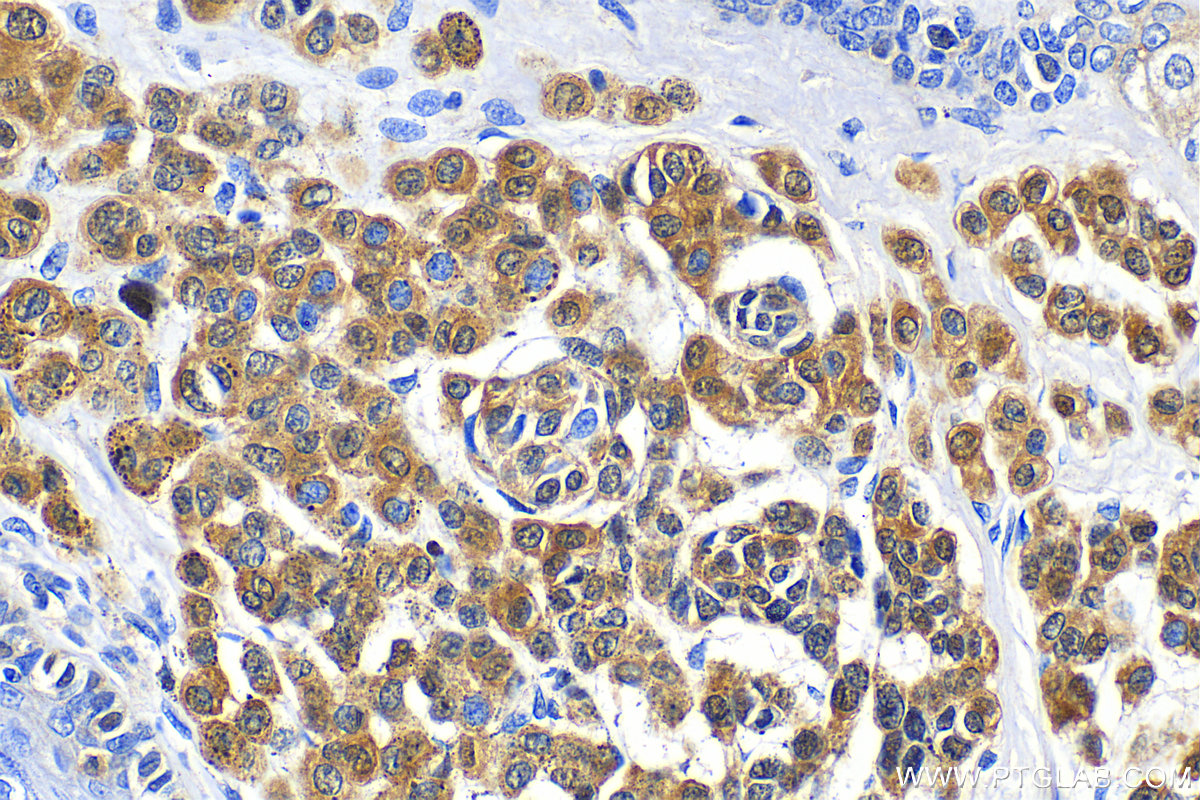 IHC staining of human malignant melanoma using 15146-1-AP