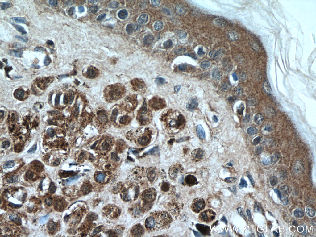 IHC staining of human malignant melanoma using 66616-1-Ig (same clone as 66616-1-PBS)