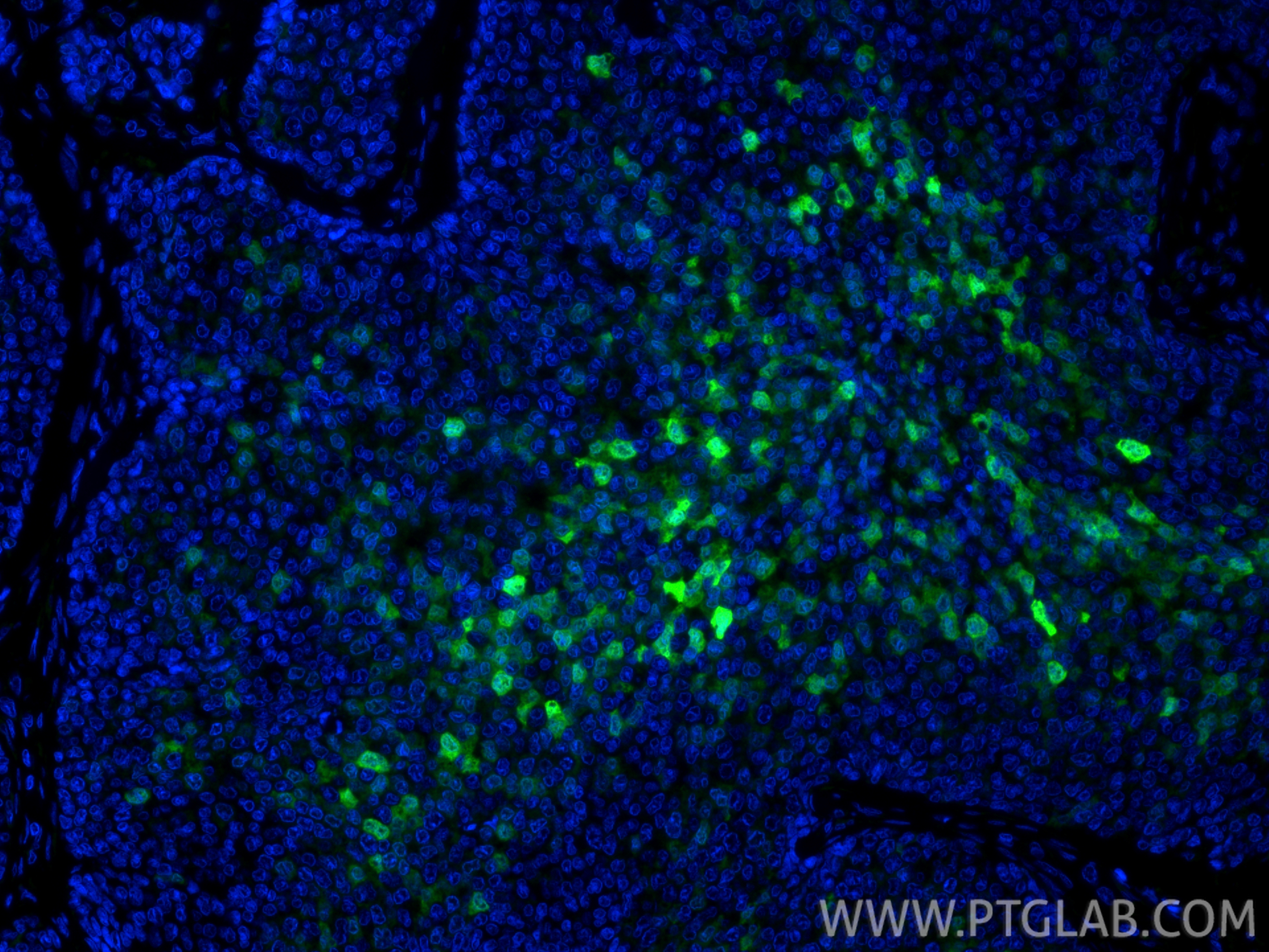 IF Staining of human breast cancer using 11803-1-AP IF Staining of human breast cancer using 11803-1-AP