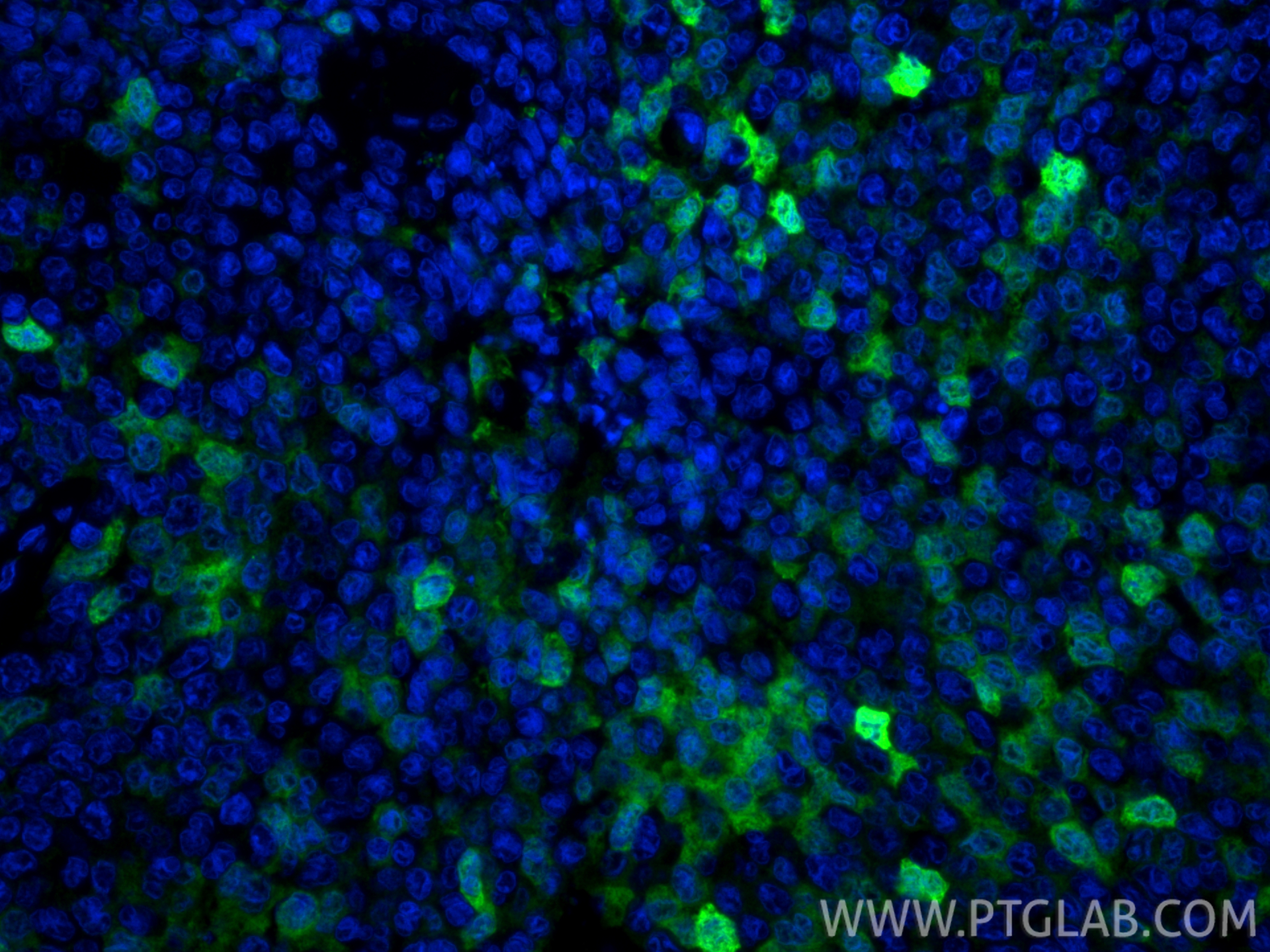IF Staining of human breast cancer using 11803-1-AP IF Staining of human breast cancer using 11803-1-AP