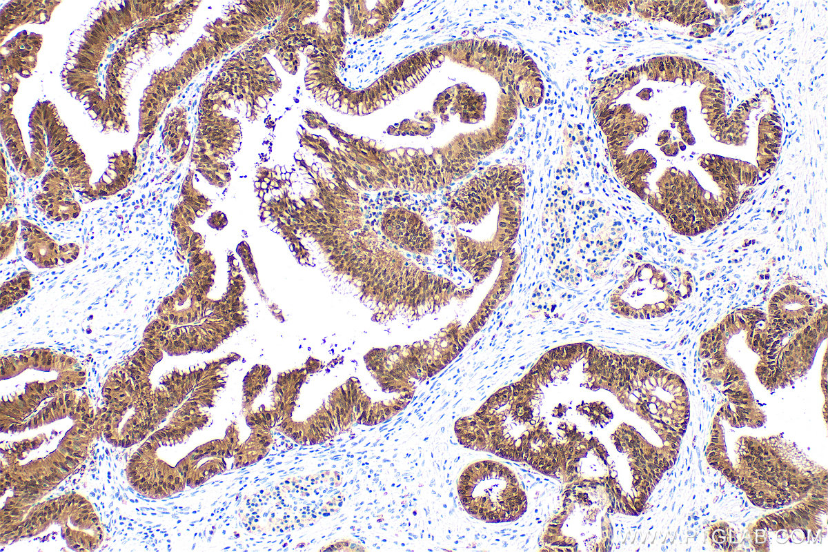 IHC staining of human pancreas cancer using 67485-1-Ig