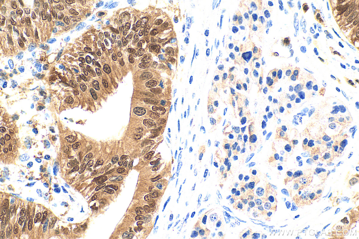 IHC staining of human pancreas cancer using 67485-1-Ig