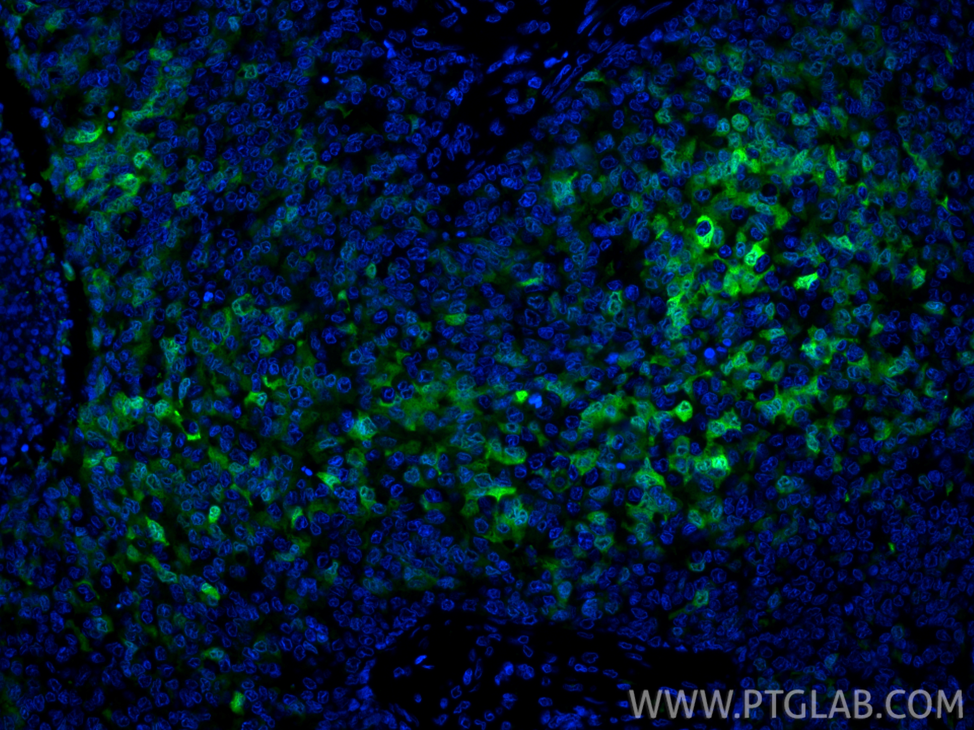 IF Staining of human breast cancer using CL488-11803 IF Staining of human breast cancer using CL488-11803