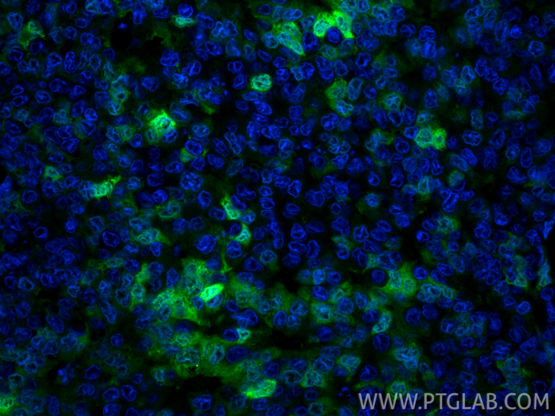 IF Staining of human breast cancer using CL488-11803 IF Staining of human breast cancer using CL488-11803