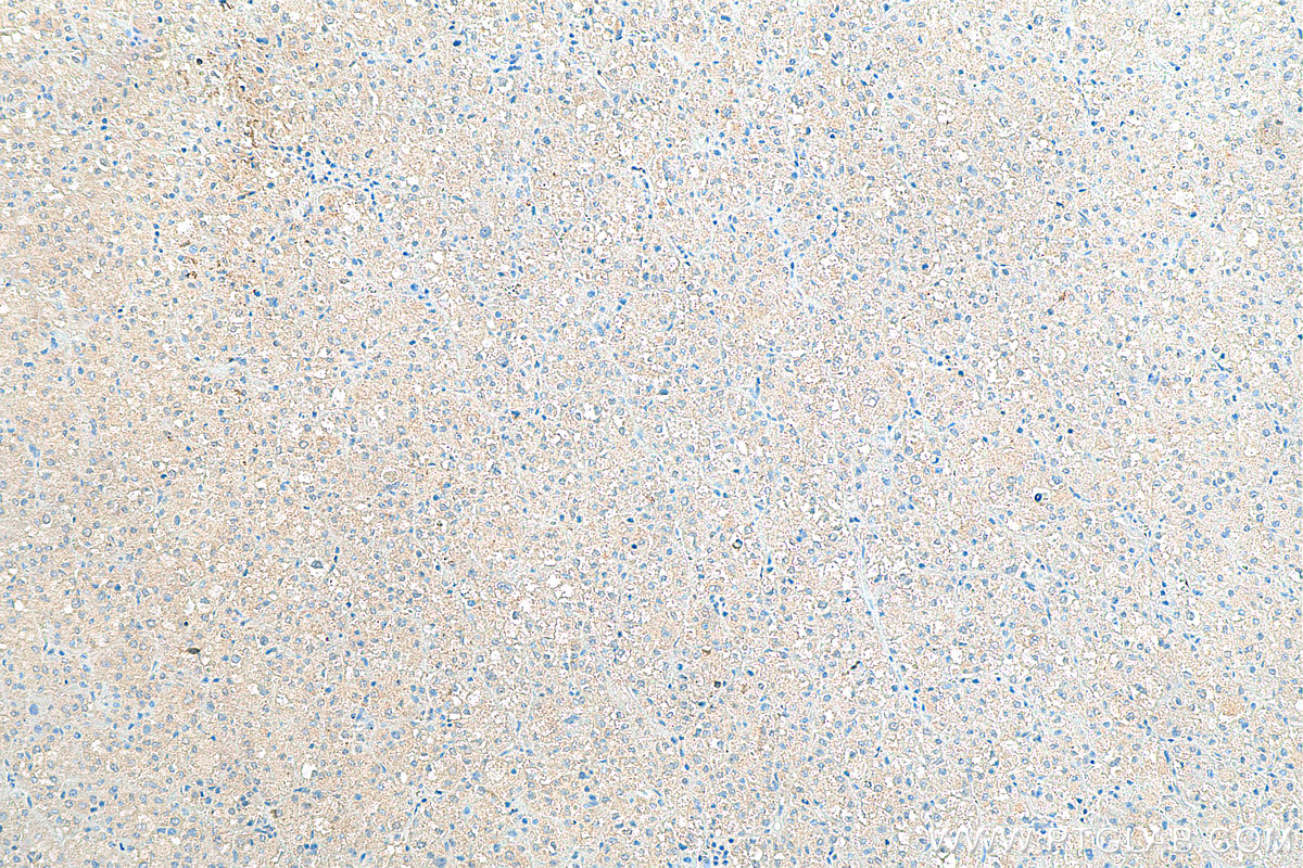 IHC staining of human liver cancer using 16721-1-AP