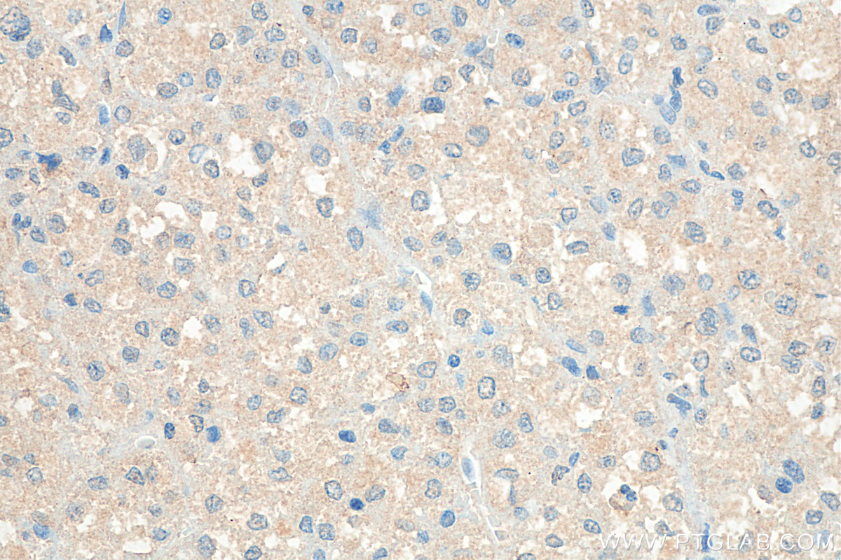 IHC staining of human liver cancer using 16721-1-AP