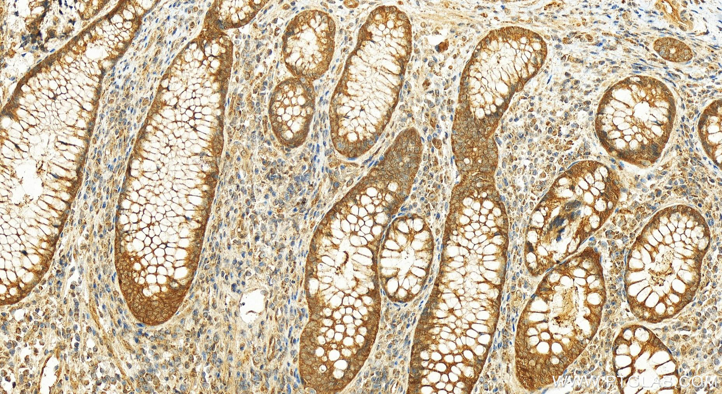Immunohistochemical analysis of paraffin-embedded human colon cancer tissue slide using 25857-1-AP (SAC3D1 antibody) at dilution of 1:200 (under 20x lens). Heat mediated antigen retrieval with Tris-EDTA buffer (pH 9.0). IHC staining of human colon cancer using 25857-1-AP