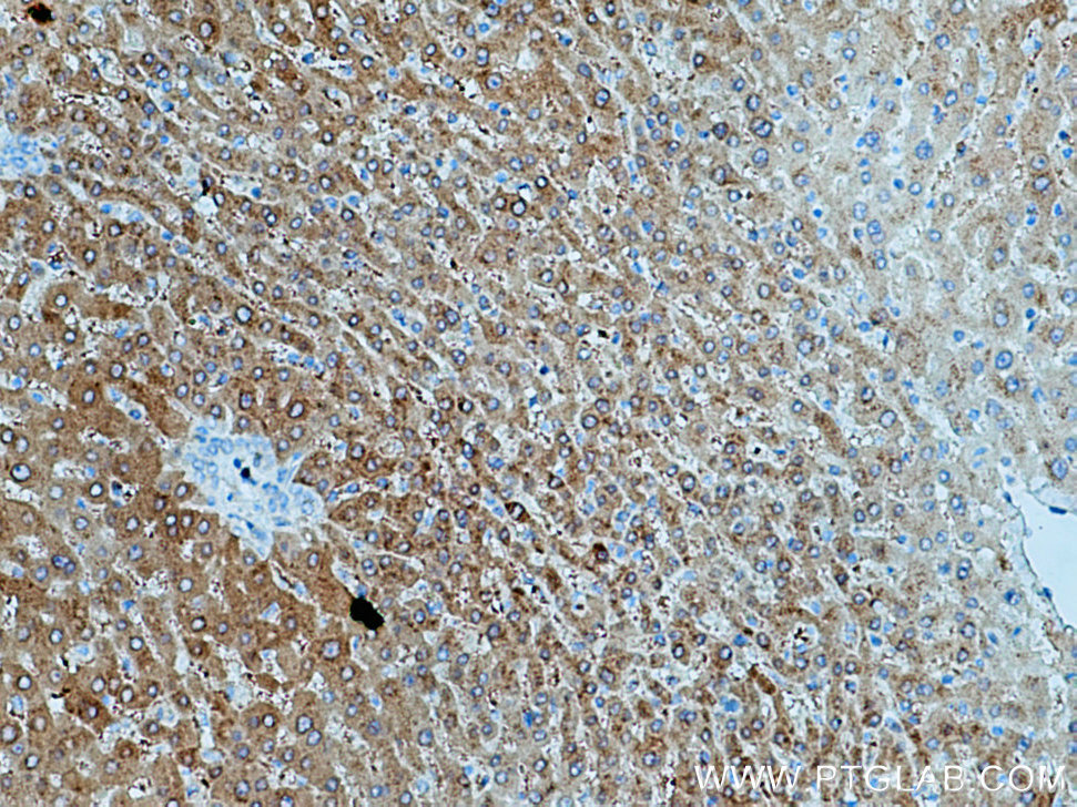Immunohistochemical analysis of paraffin-embedded human liver cancer tissue slide using 25857-1-AP (SAC3D1 antibody) at dilution of 1:200 (under 10x lens). Heat mediated antigen retrieval with Tris-EDTA buffer (pH 9.0). IHC staining of human liver cancer using 25857-1-AP