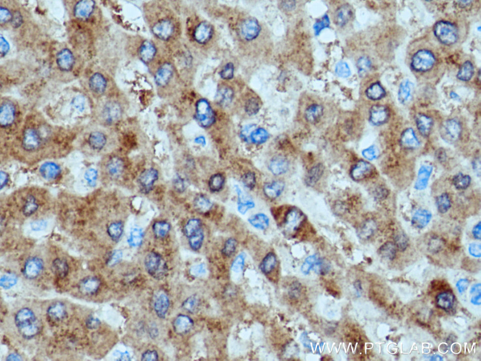 Immunohistochemical analysis of paraffin-embedded human liver cancer tissue slide using 25857-1-AP (SAC3D1 antibody) at dilution of 1:200 (under 40x lens). Heat mediated antigen retrieval with Tris-EDTA buffer (pH 9.0). IHC staining of human liver cancer using 25857-1-AP