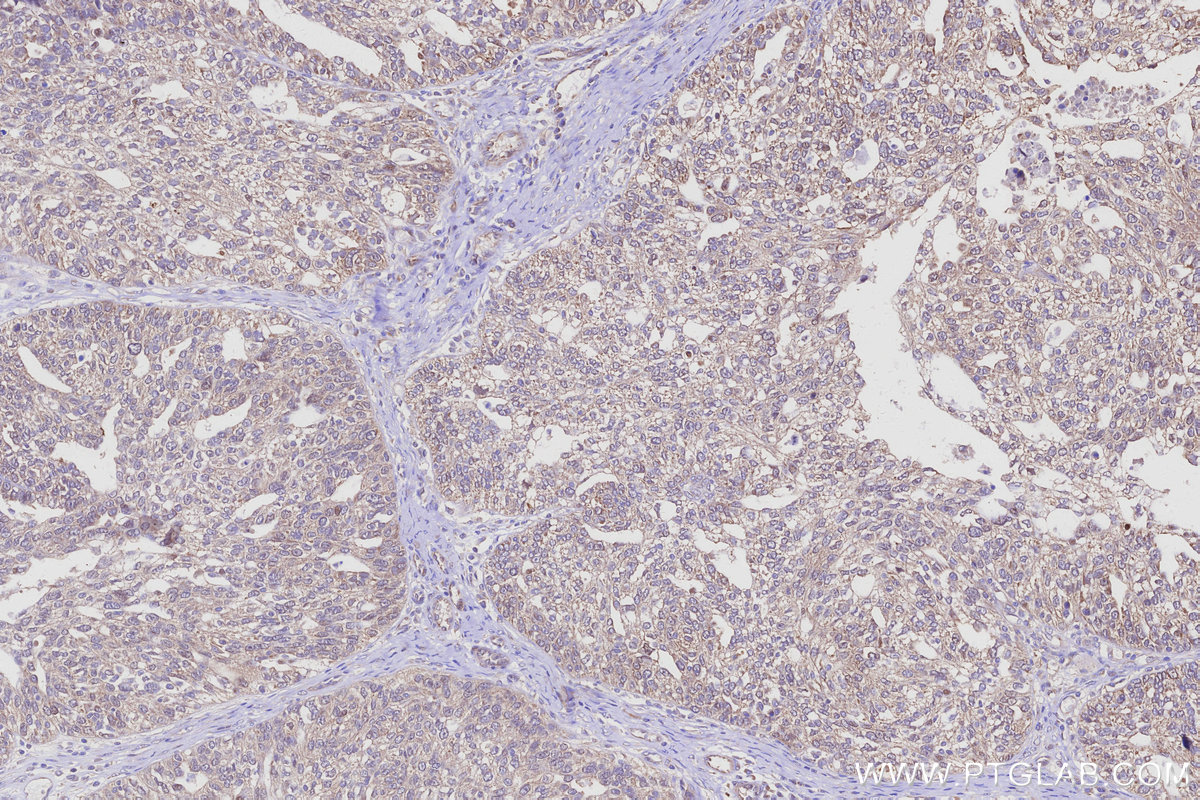 IHC staining of human ovary cancer using 25857-1-AP