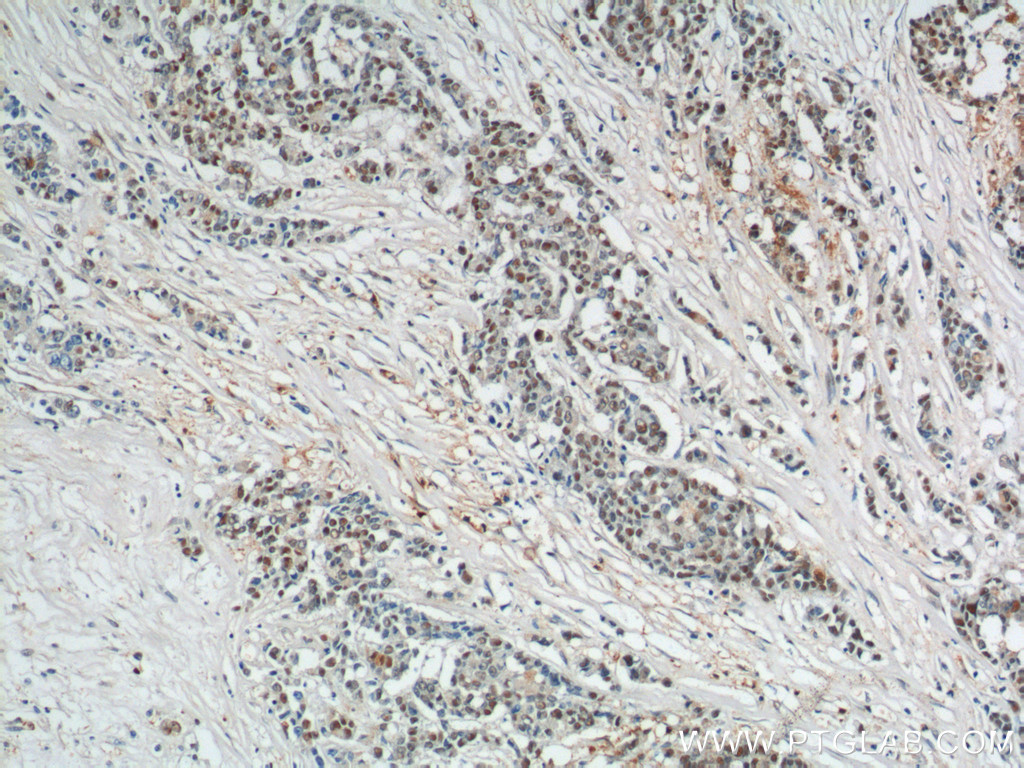 IHC staining of human colon cancer using 10229-1-AP