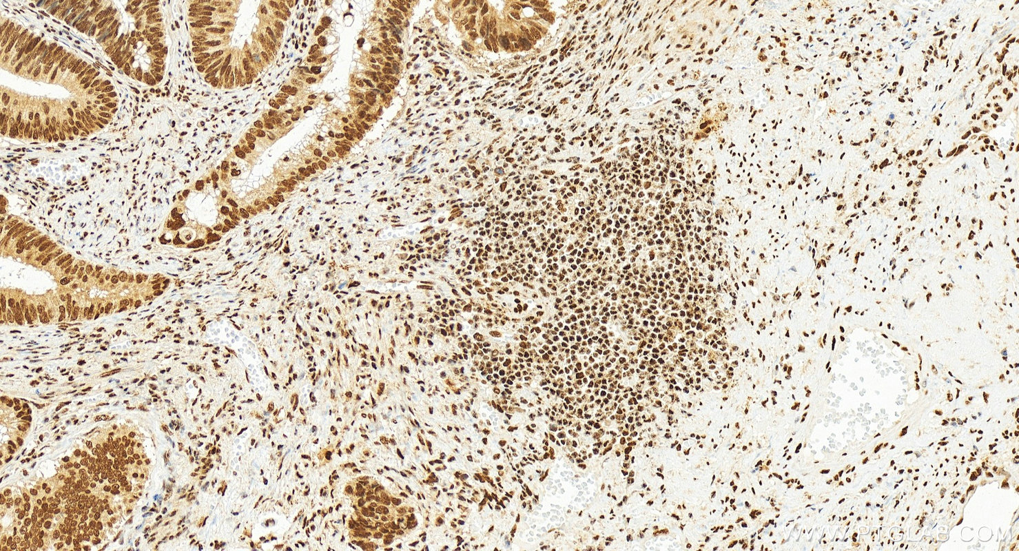 IHC staining of human colon cancer using 84516-6-RR