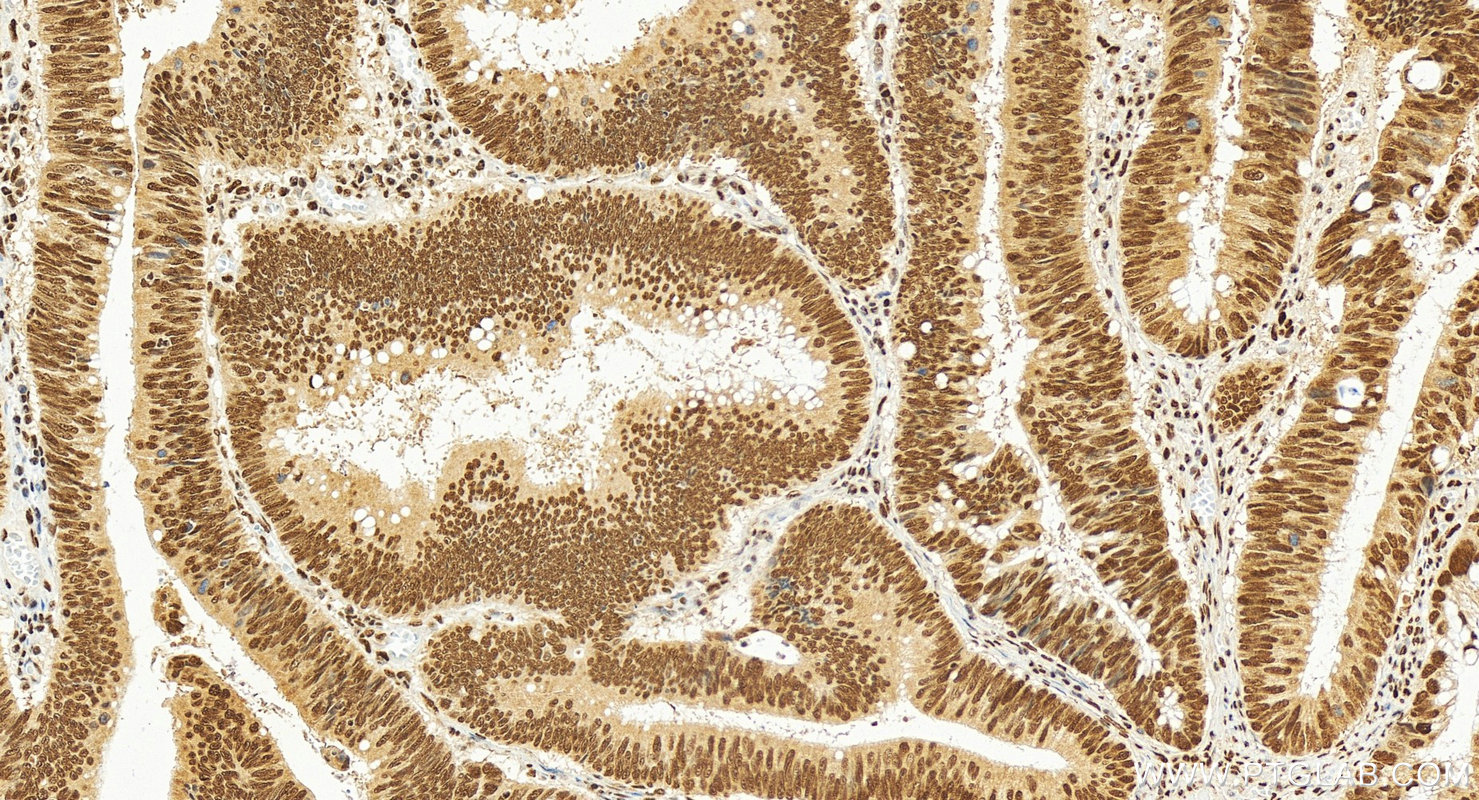 IHC staining of human colon cancer using 84516-6-RR