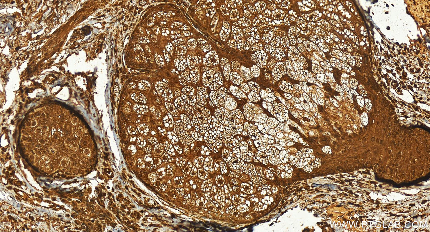 IHC staining of human skin cancer using 30914-1-AP