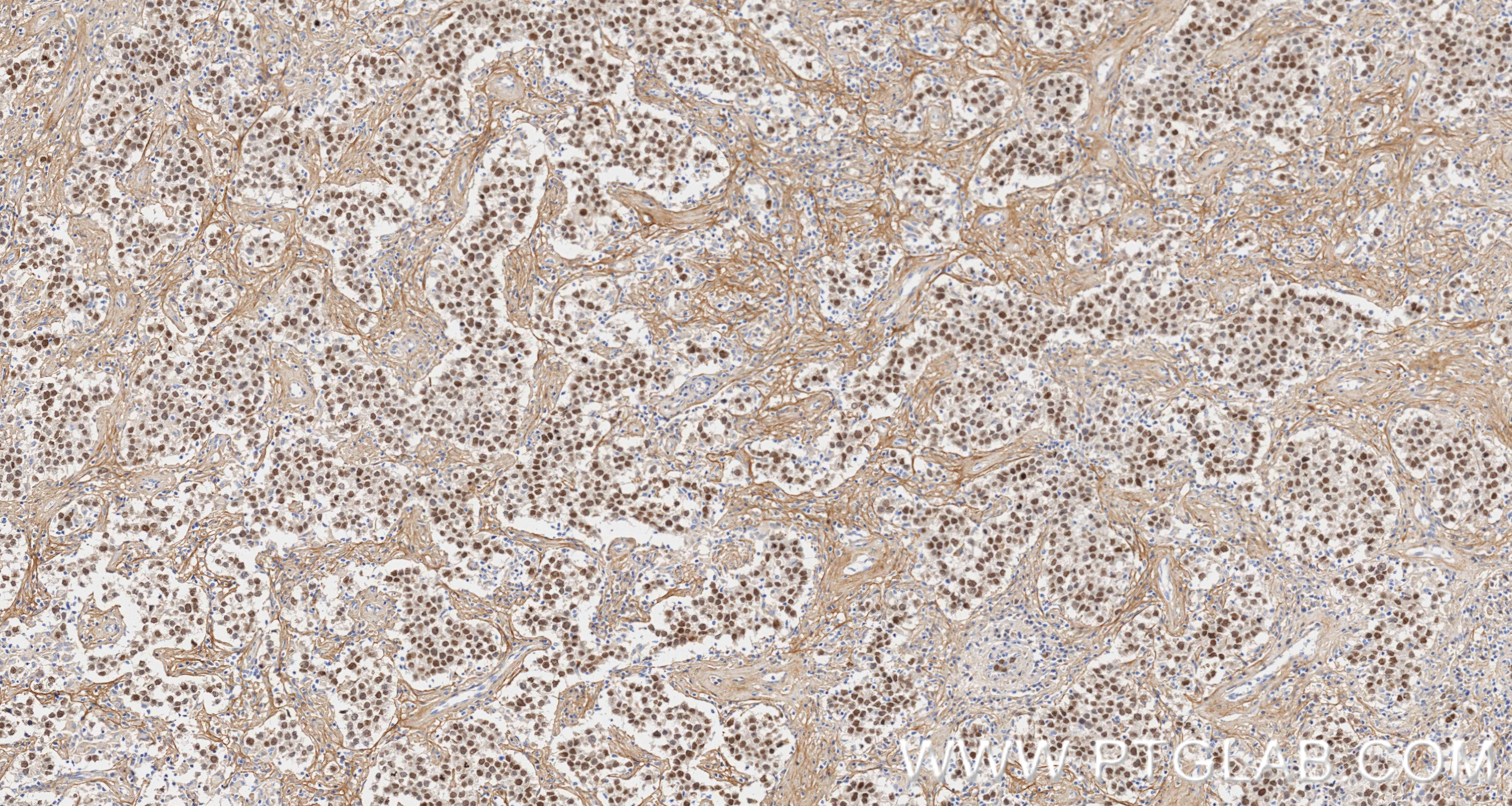 Immunohistochemical analysis of paraffin-embedded Human seminoma slide using 83039-4-RR (SALL4 antibody) at dilution of 1:2000 (under 10x lens). Heat mediated antigen retrieval with Tris-EDTA buffer (pH 9.0). IHC staining of Human seminoma using 83039-4-RR