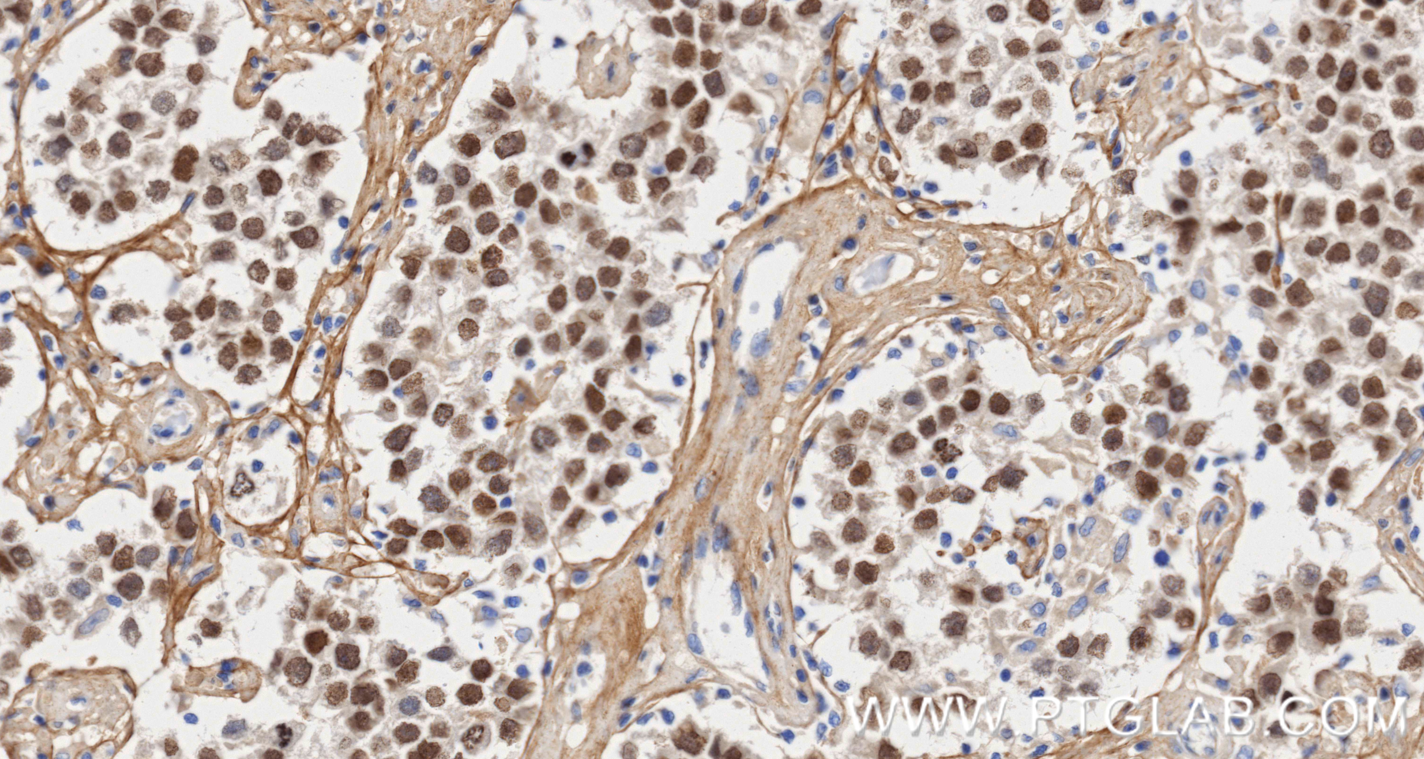 Immunohistochemical analysis of paraffin-embedded Human seminoma slide using 83039-4-RR (SALL4 antibody) at dilution of 1:2000 (under 40x lens). Heat mediated antigen retrieval with Tris-EDTA buffer (pH 9.0). IHC staining of Human seminoma using 83039-4-RR