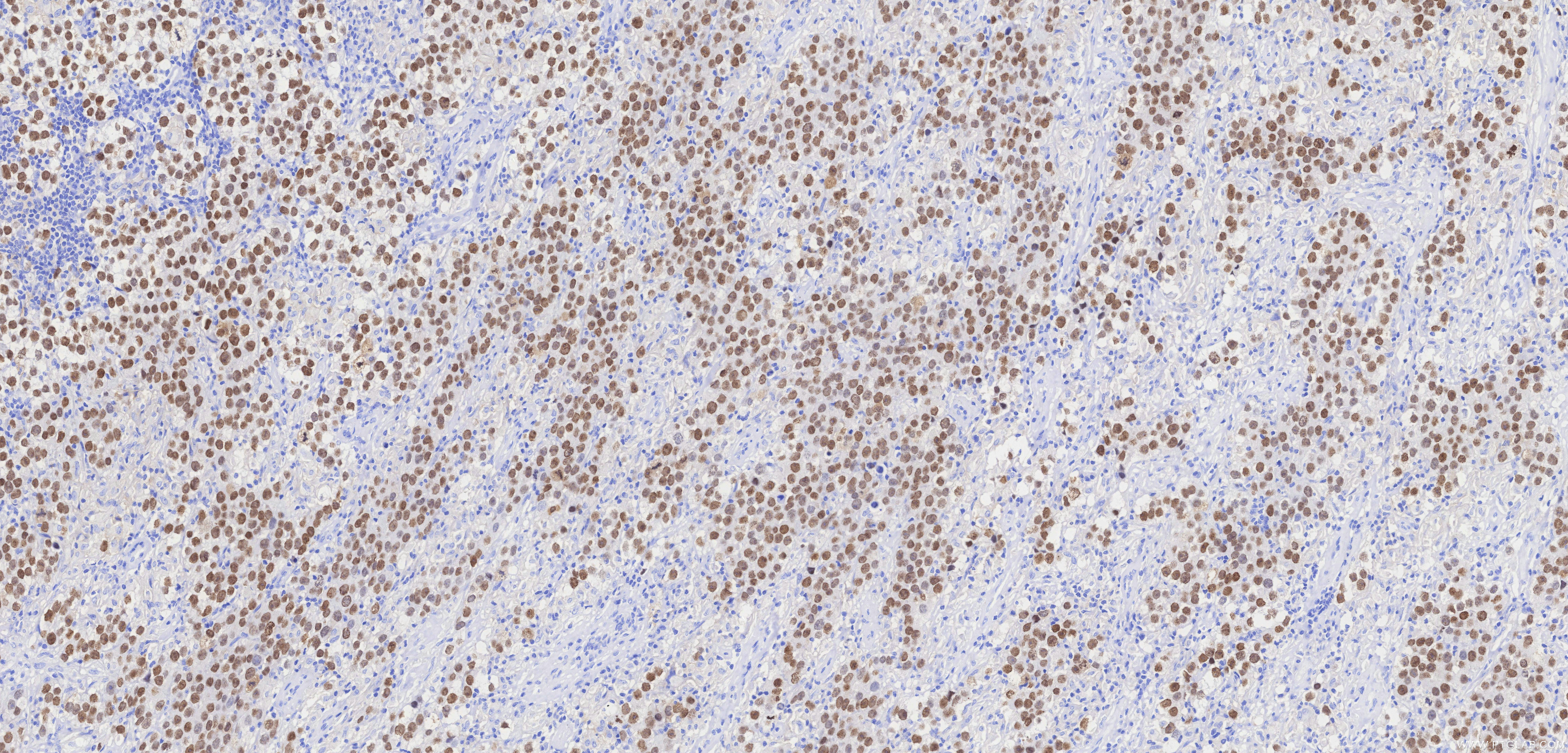 IHC staining of Human seminoma using 83039-7-RR (same clone as 83039-7-PBS)