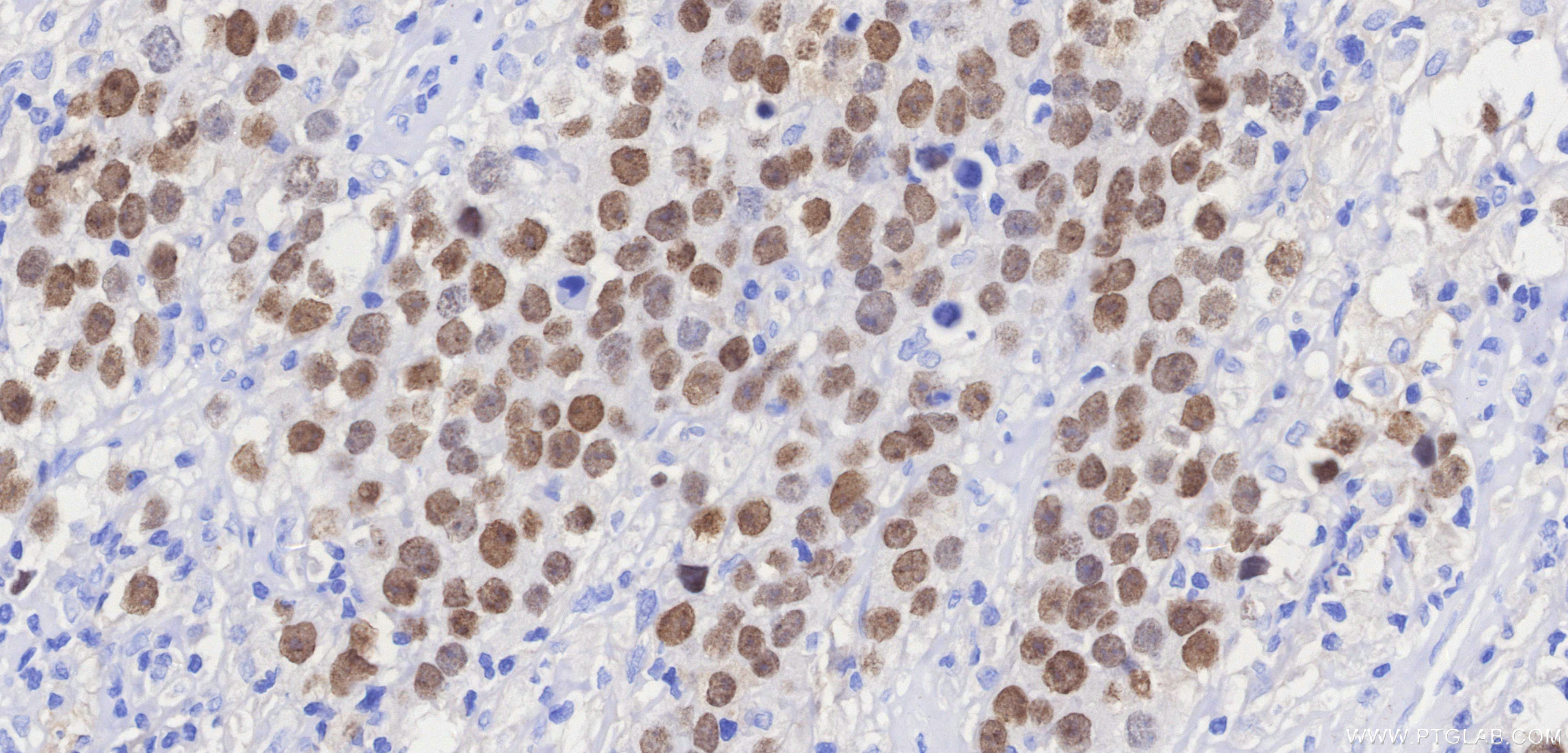 IHC staining of Human seminoma using 83039-7-RR (same clone as 83039-7-PBS)