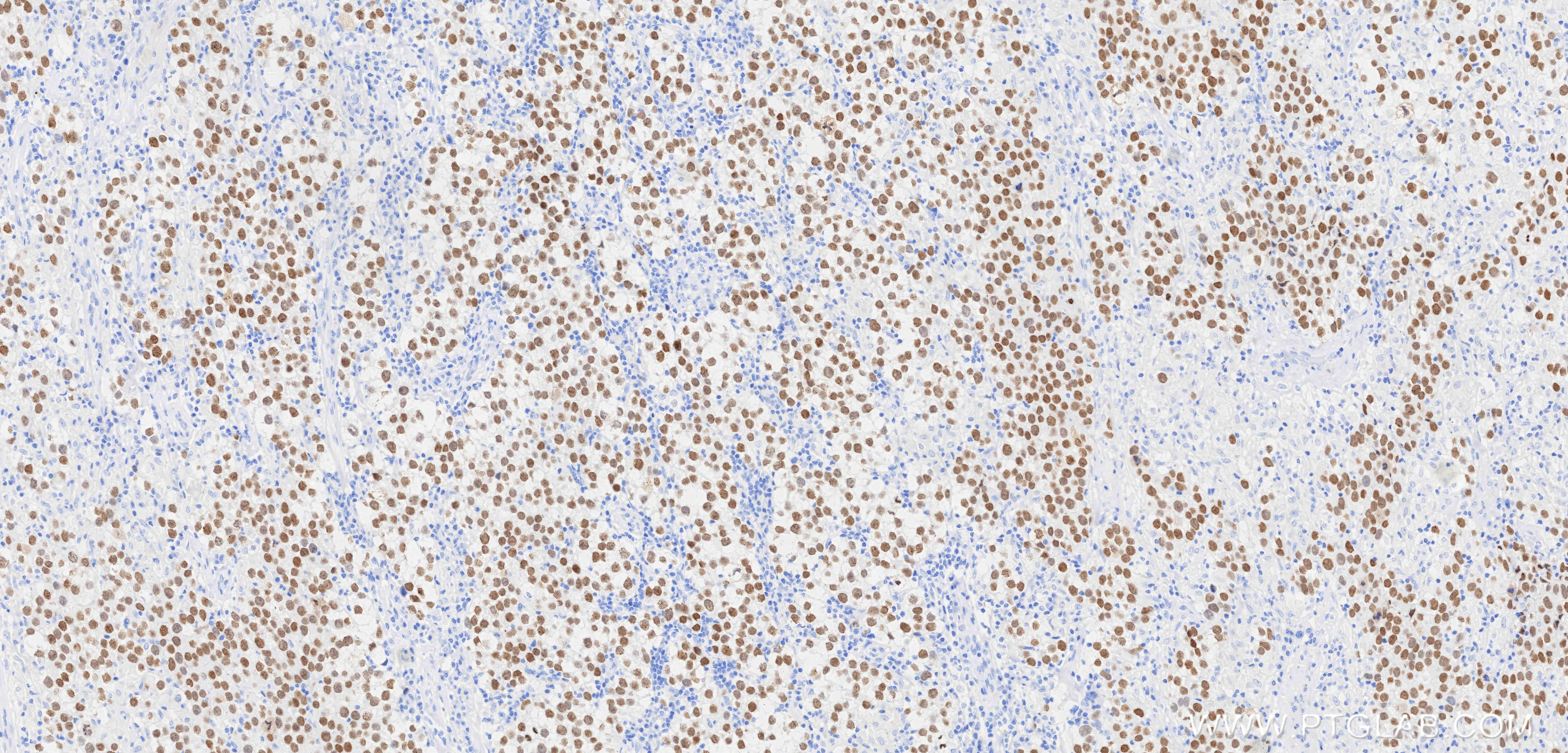 IHC staining of human seminoma using 83039-8-RR IHC staining of human seminoma using 83039-8-RR