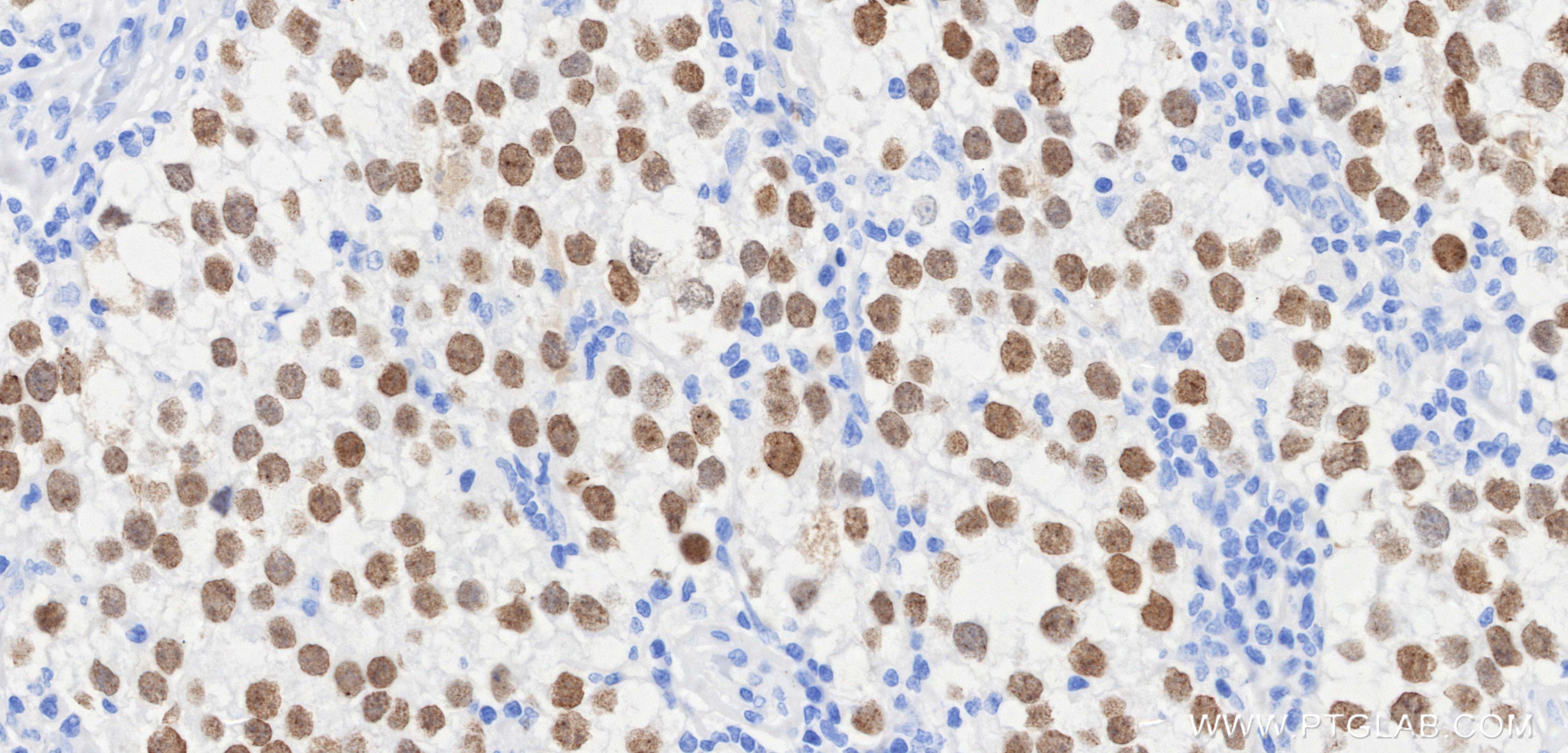 IHC staining of human seminoma using 83039-8-RR IHC staining of human seminoma using 83039-8-RR