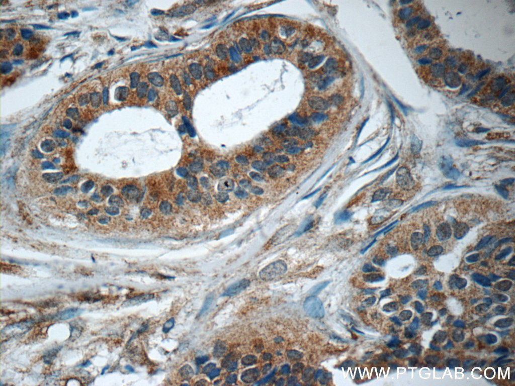 IHC staining of human breast cancer using 25173-1-AP
