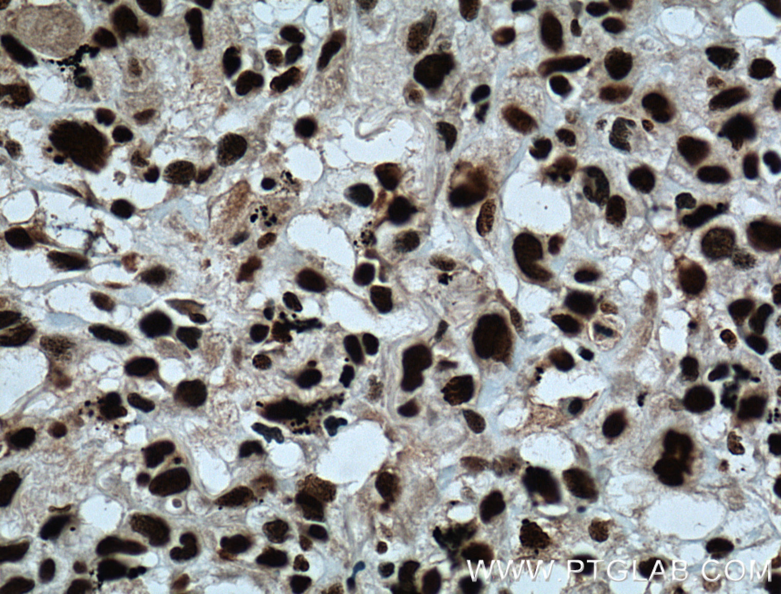 IHC staining of human lung cancer using 12586-1-AP