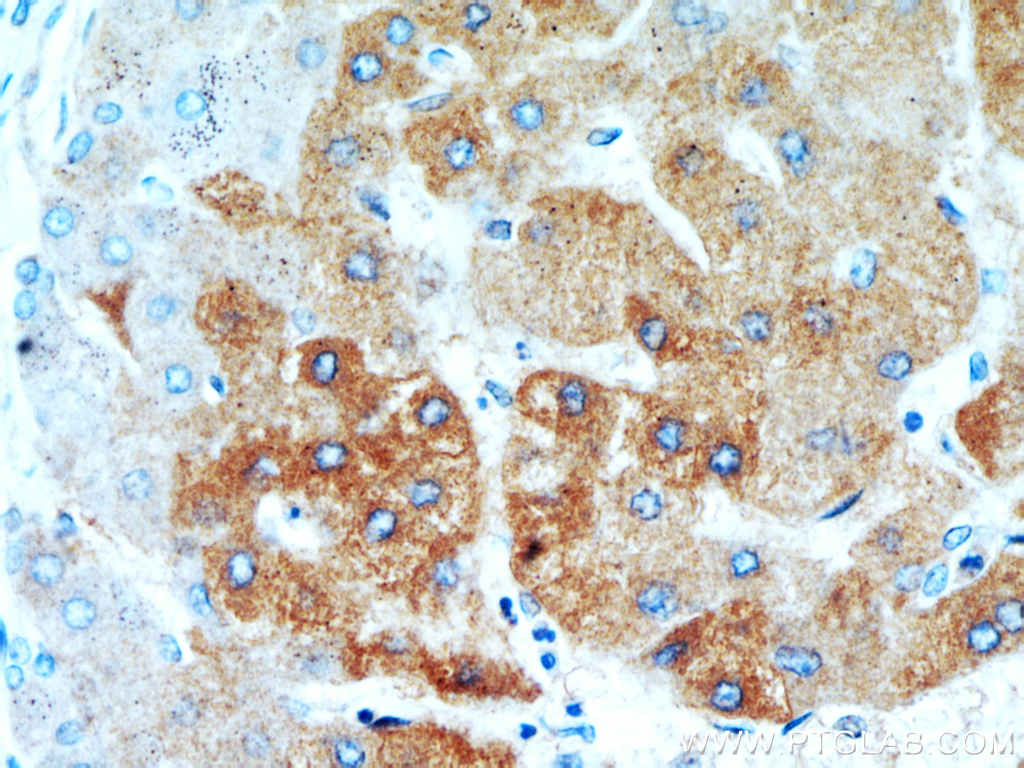 IHC staining of human hepatocirrhosis using 20824-1-AP