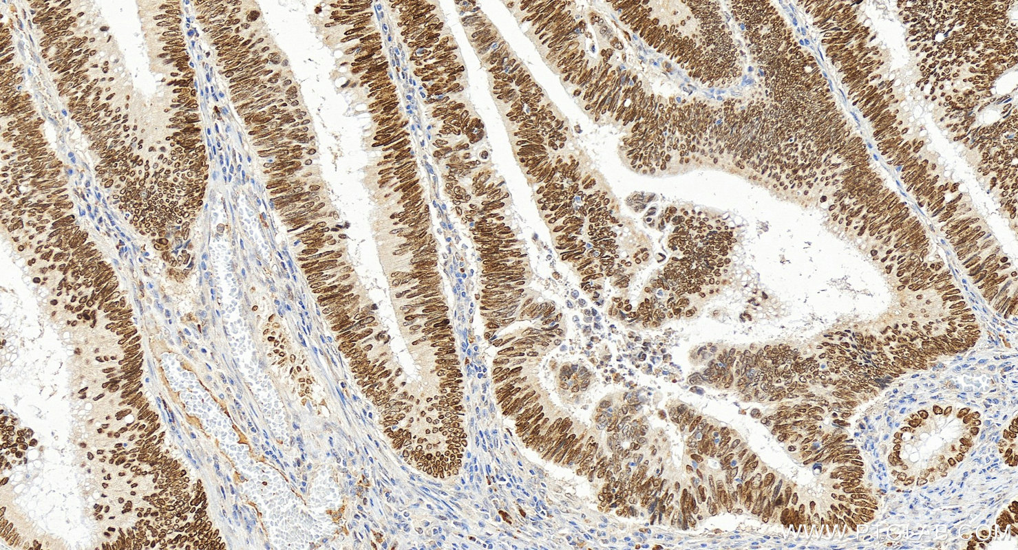 IHC staining of human colon cancer using 30717-1-AP