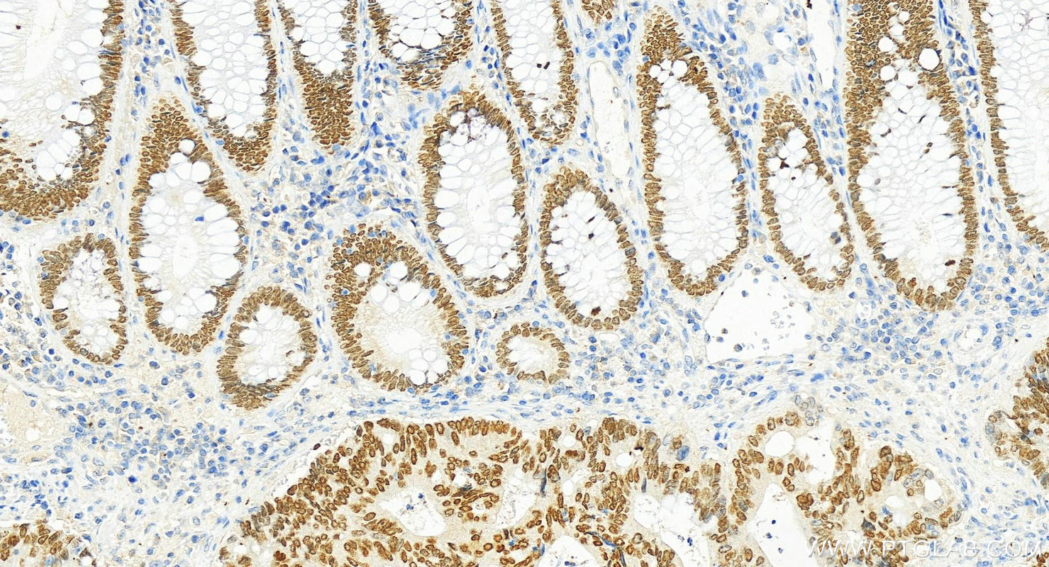 IHC staining of human colon cancer using 67958-1-Ig