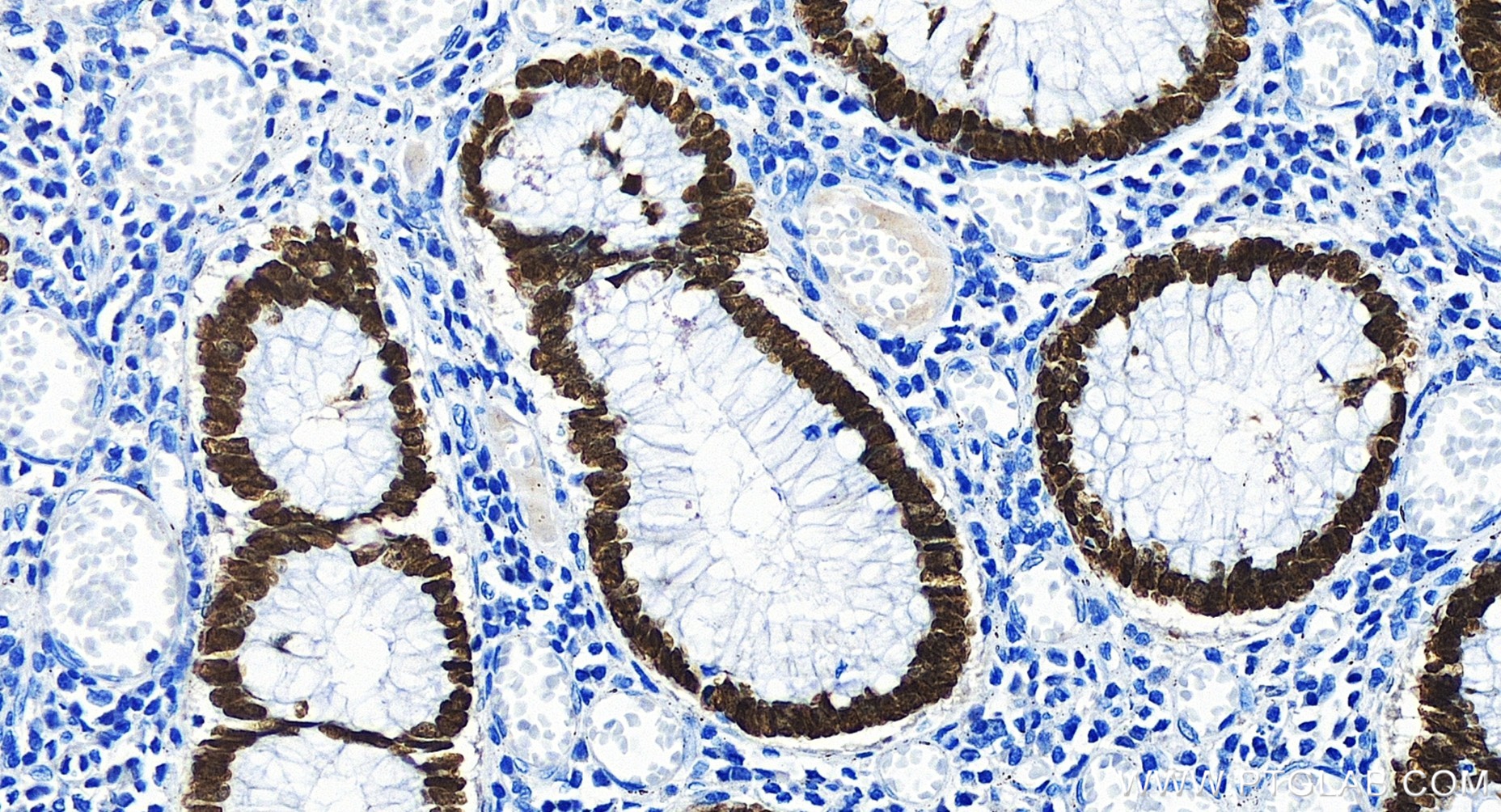 IHC staining of human colon cancer using 85922-1-RR (same clone as 85922-1-PBS)