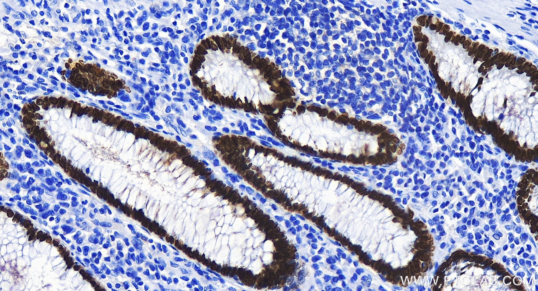 IHC staining of human colon cancer using 85922-1-RR (same clone as 85922-1-PBS)