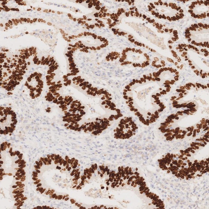 IHC staining of human colorectal cancer using 85922-1-RR IHC staining of human colorectal cancer using 85922-1-RR