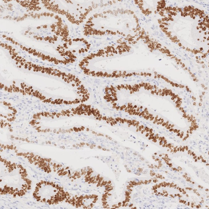 IHC staining of human colorectal cancer using 85922-1-RR IHC staining of human colorectal cancer using 85922-1-RR