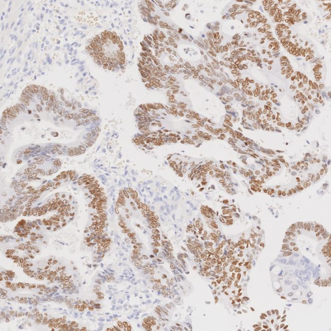 IHC staining of human colorectal cancer using 85922-1-RR IHC staining of human colorectal cancer using 85922-1-RR