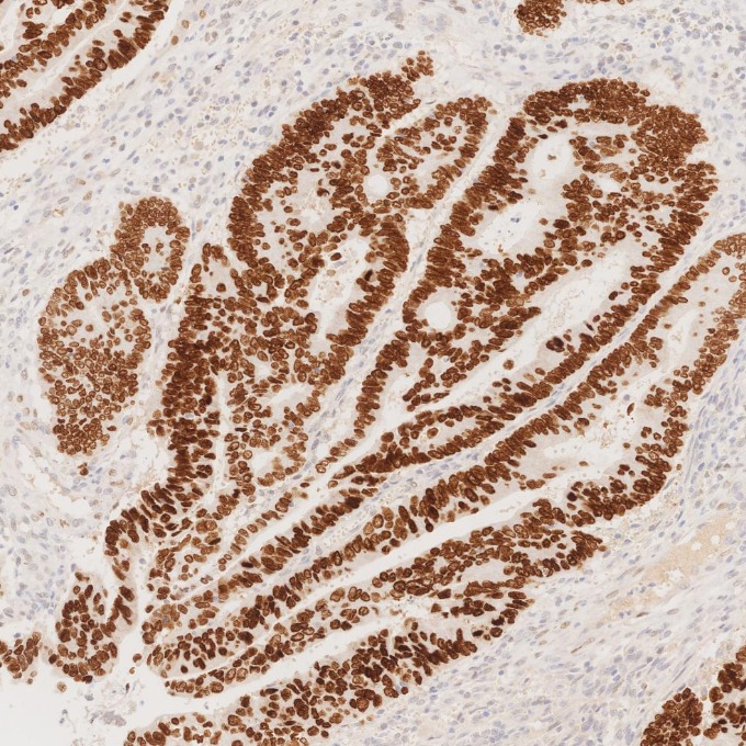 IHC staining of human colorectal cancer using 85922-1-RR IHC staining of human colorectal cancer using 85922-1-RR