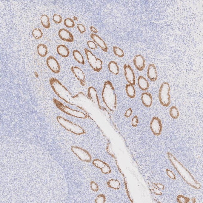 IHC staining of human appendicitis using 85922-1-RR IHC staining of human appendicitis using 85922-1-RR