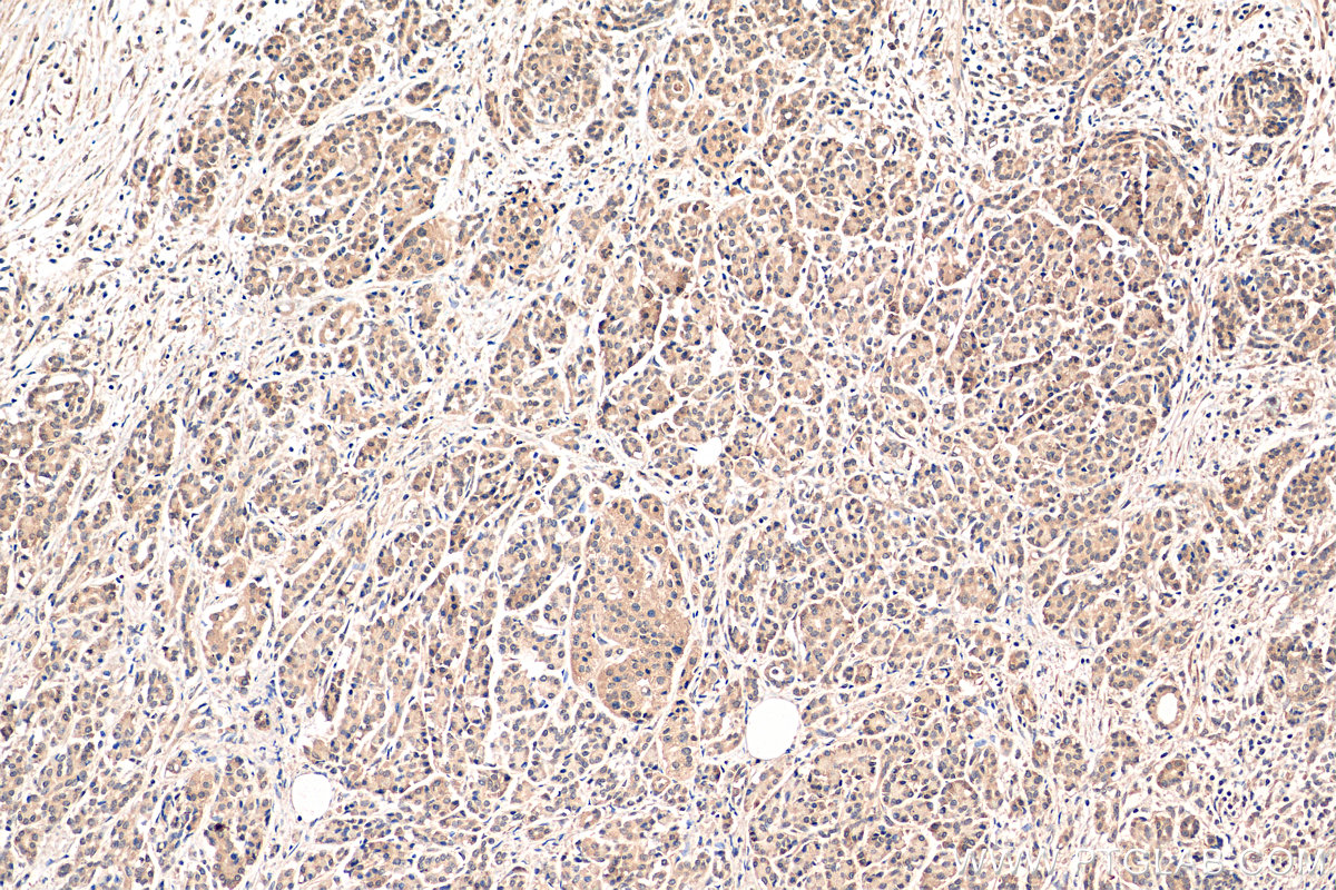 IHC staining of human pancreas cancer using 17618-1-AP