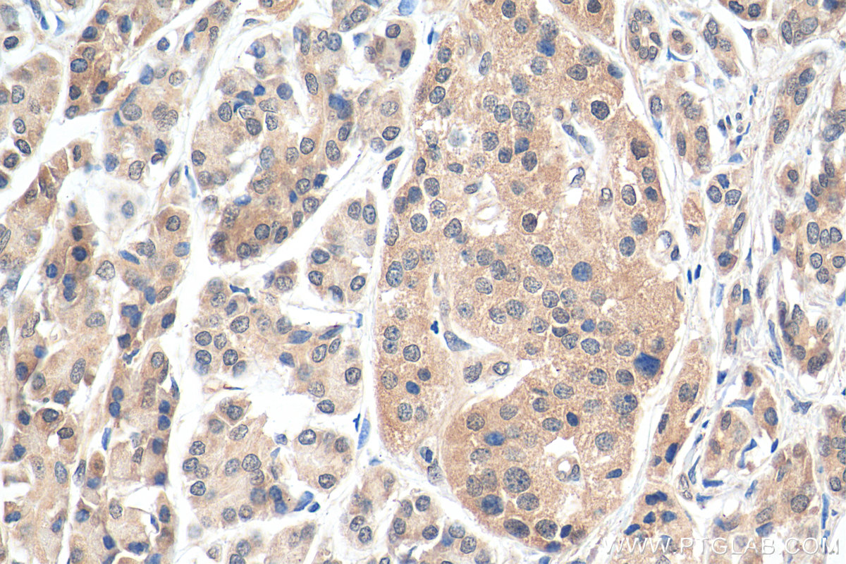 IHC staining of human pancreas cancer using 17618-1-AP