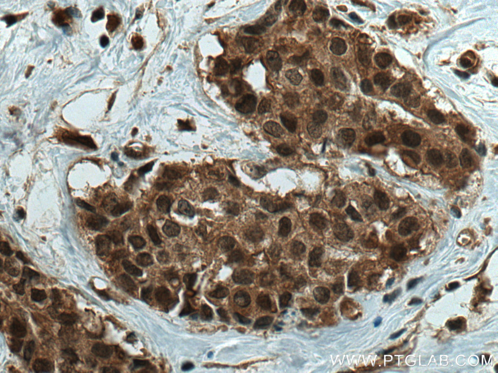 IHC staining of human breast cancer using 67200-1-Ig