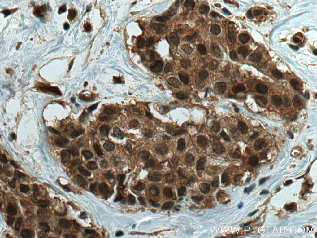 IHC staining of human breast cancer using 67200-1-Ig (same clone as 67200-1-PBS)