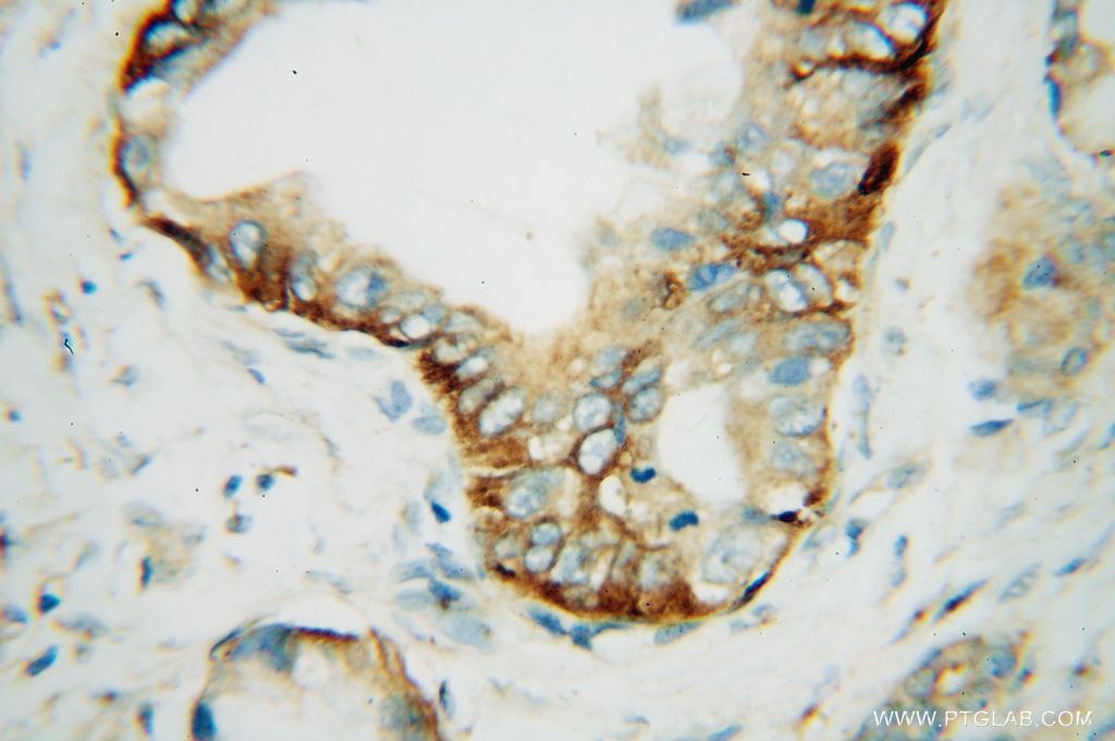 IHC staining of human pancreas cancer using 15119-1-AP