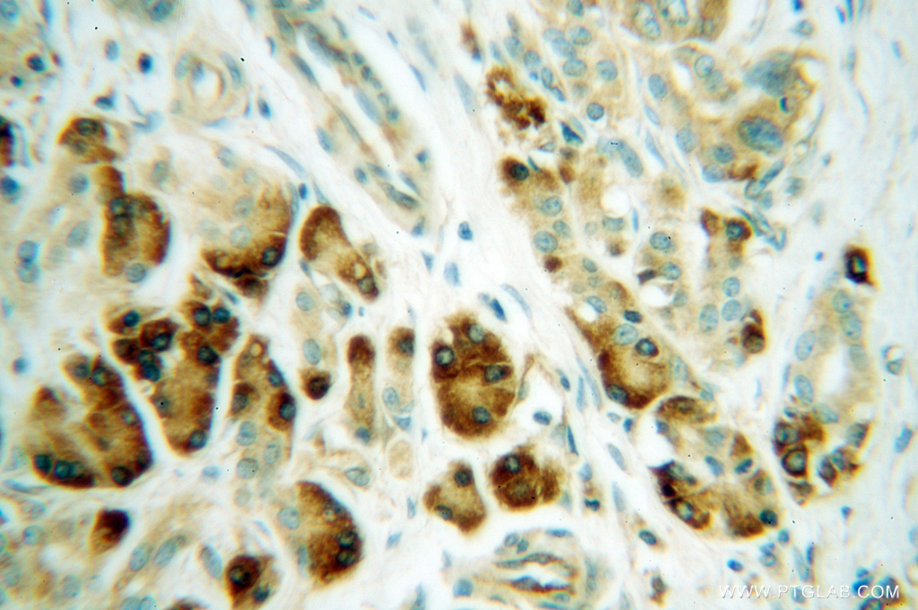 IHC staining of human pancreas cancer using 14799-1-AP