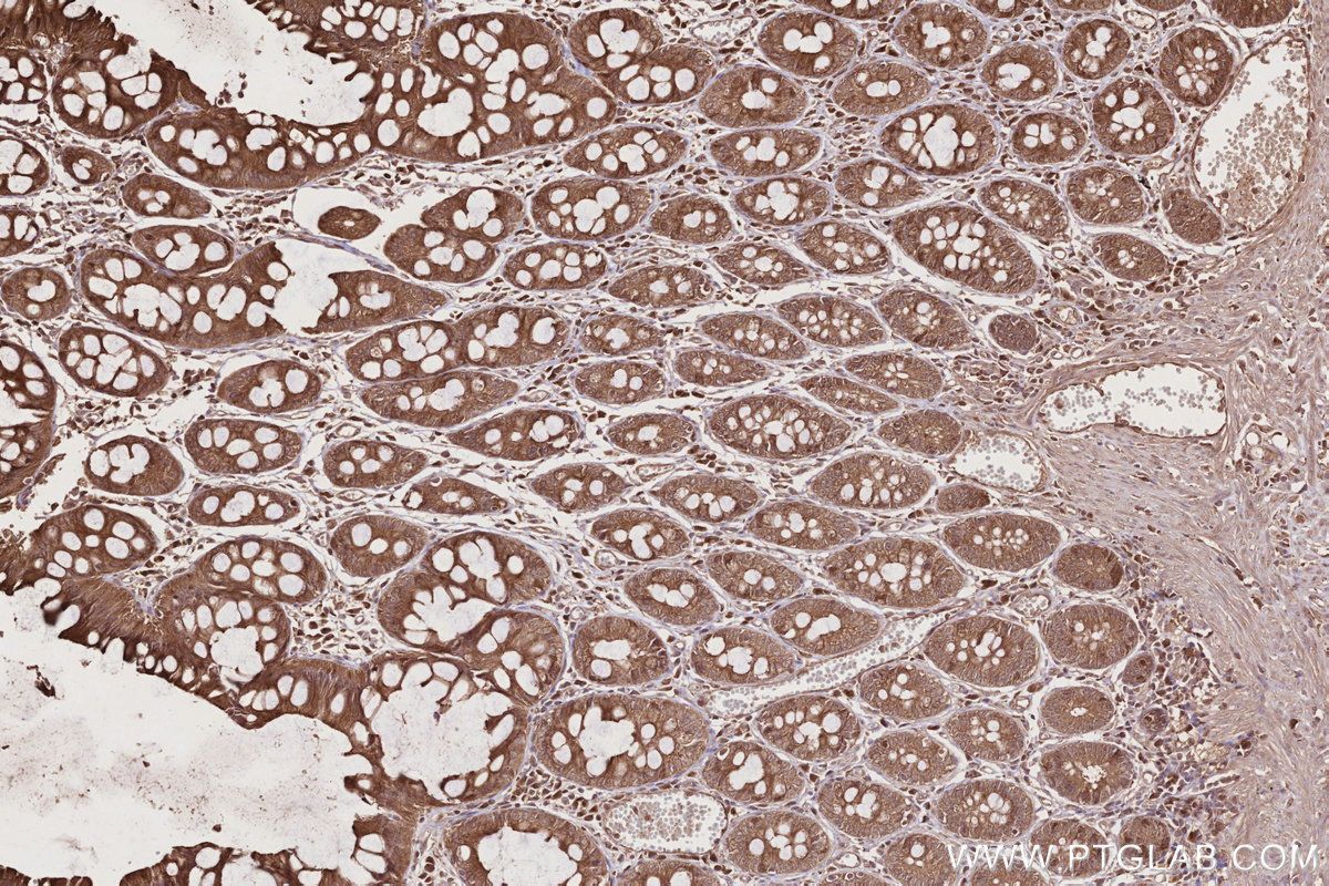 IHC staining of human rectal cancer using 12569-1-AP