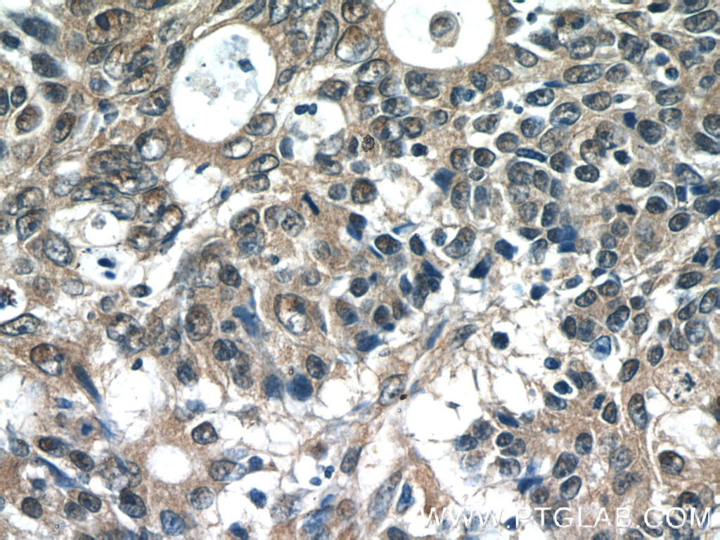 IHC staining of human colon cancer using 13375-1-AP