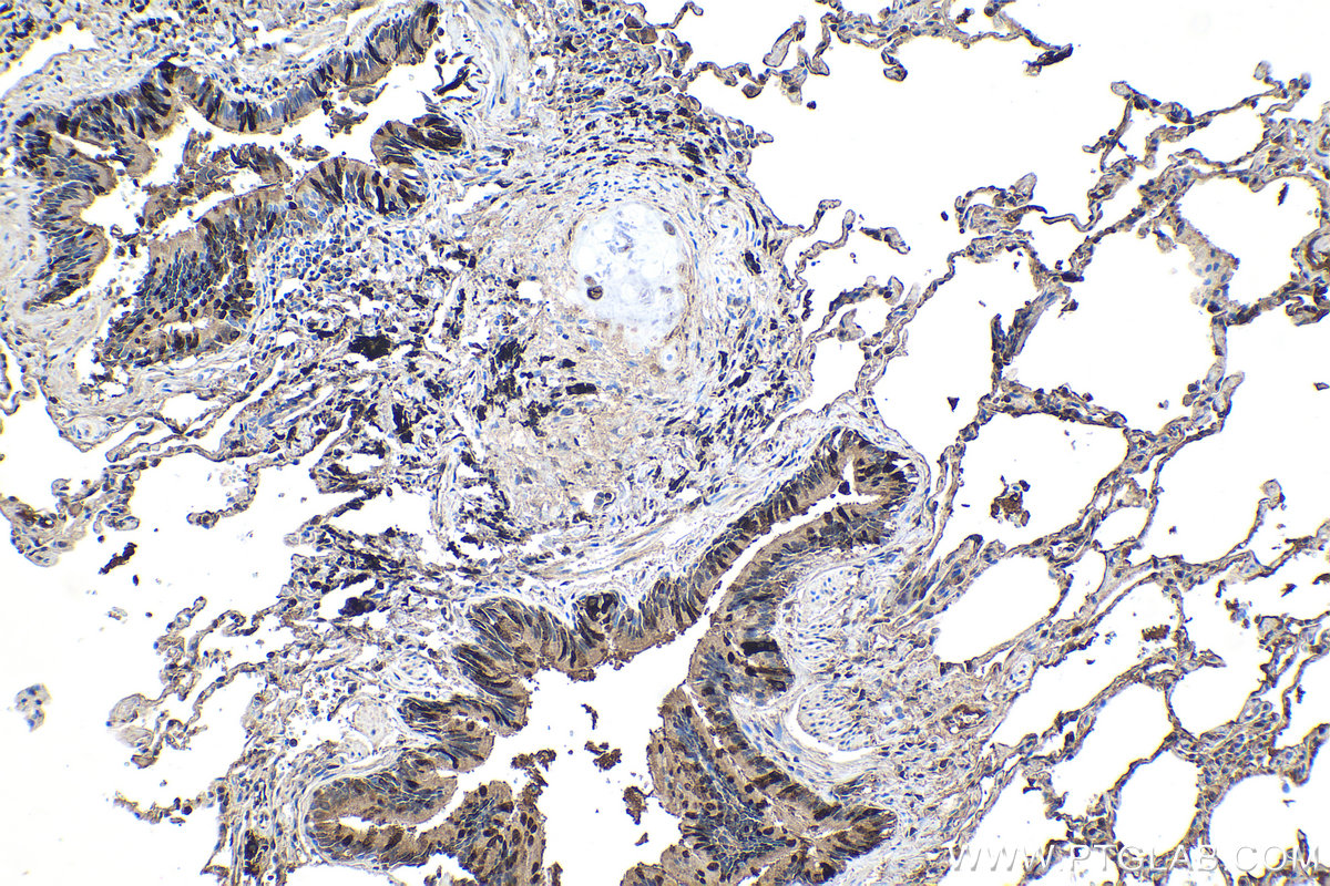 IHC staining of human lung cancer using 10490-1-AP