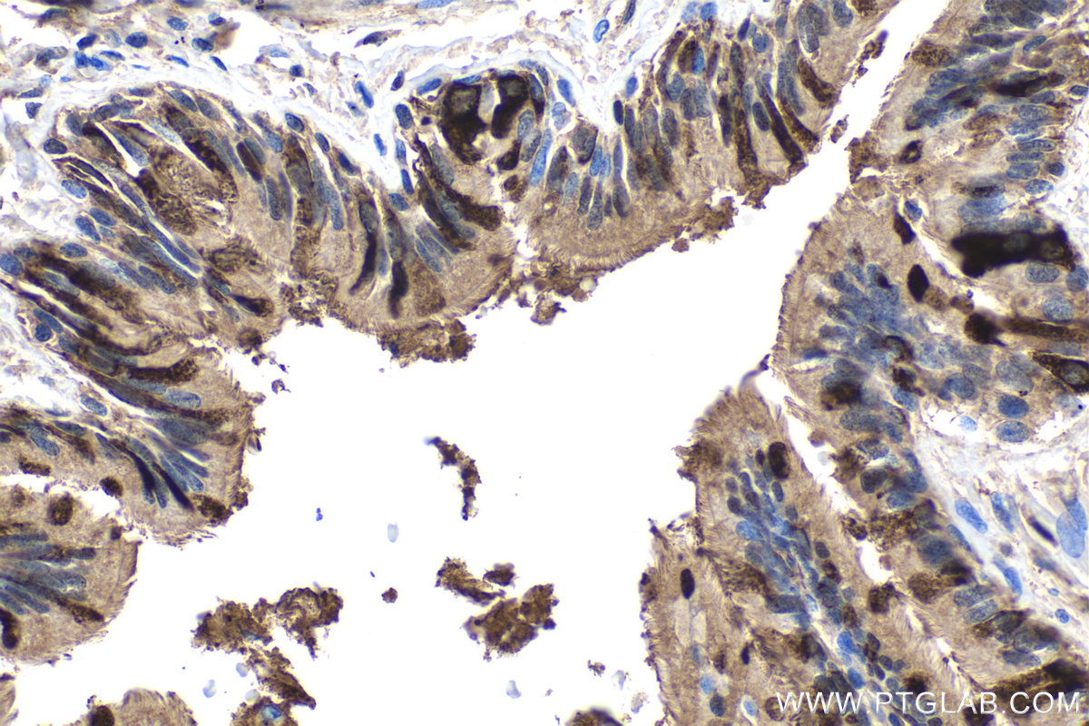 IHC staining of human lung cancer using 10490-1-AP